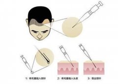 SEP超级微针植发和其他技术有何不同