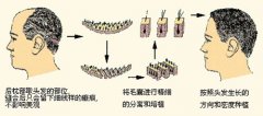 广州植发怎么样